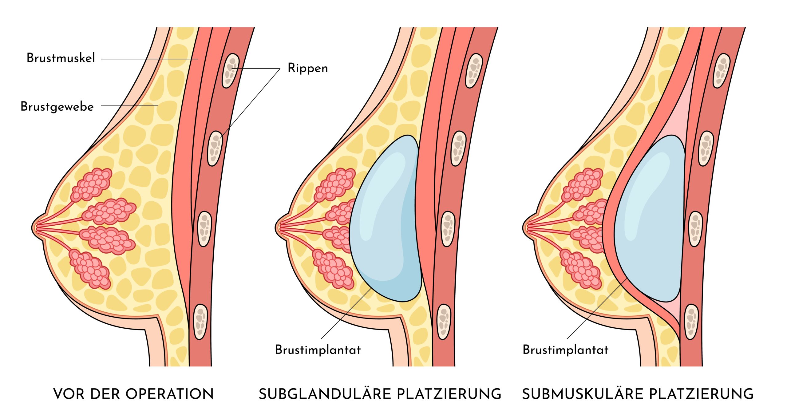 Vergleich, wie Brustimplantat bei Brustvergrößerung platziert werden kann. Möglichkeiten: unter oder über dem Brustmuskel